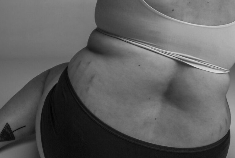 Kobieta która zaczęła stosować kwasy na rozstępy