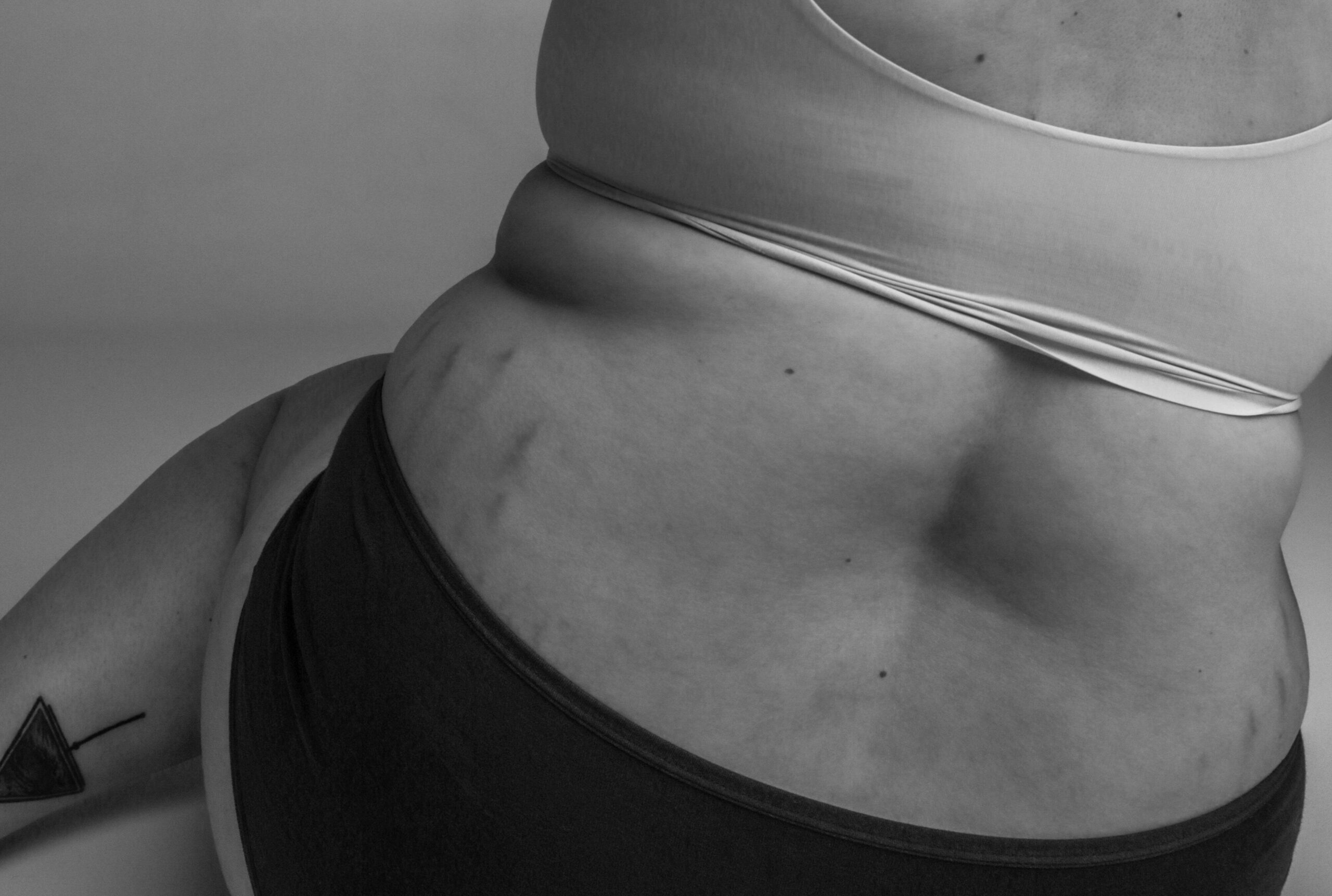 Kobieta która zaczęła stosować kwasy na rozstępy