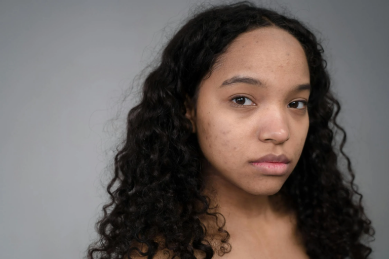 Dziewczyna mająca wypryski na twarzy